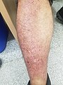 Lichen amyloidosis on a 56-year-old male's leg