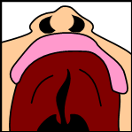 Incomplete cleft palate