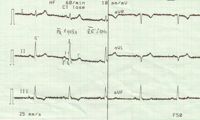 Datei:Standard-ekg.jpg