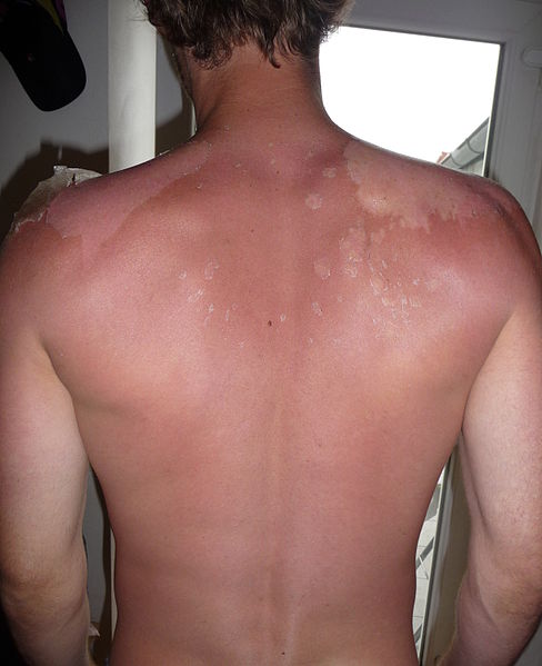 File:Sunburnt back.jpg