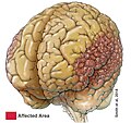 Polymicrogyria