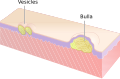 Vesicles and Bulla