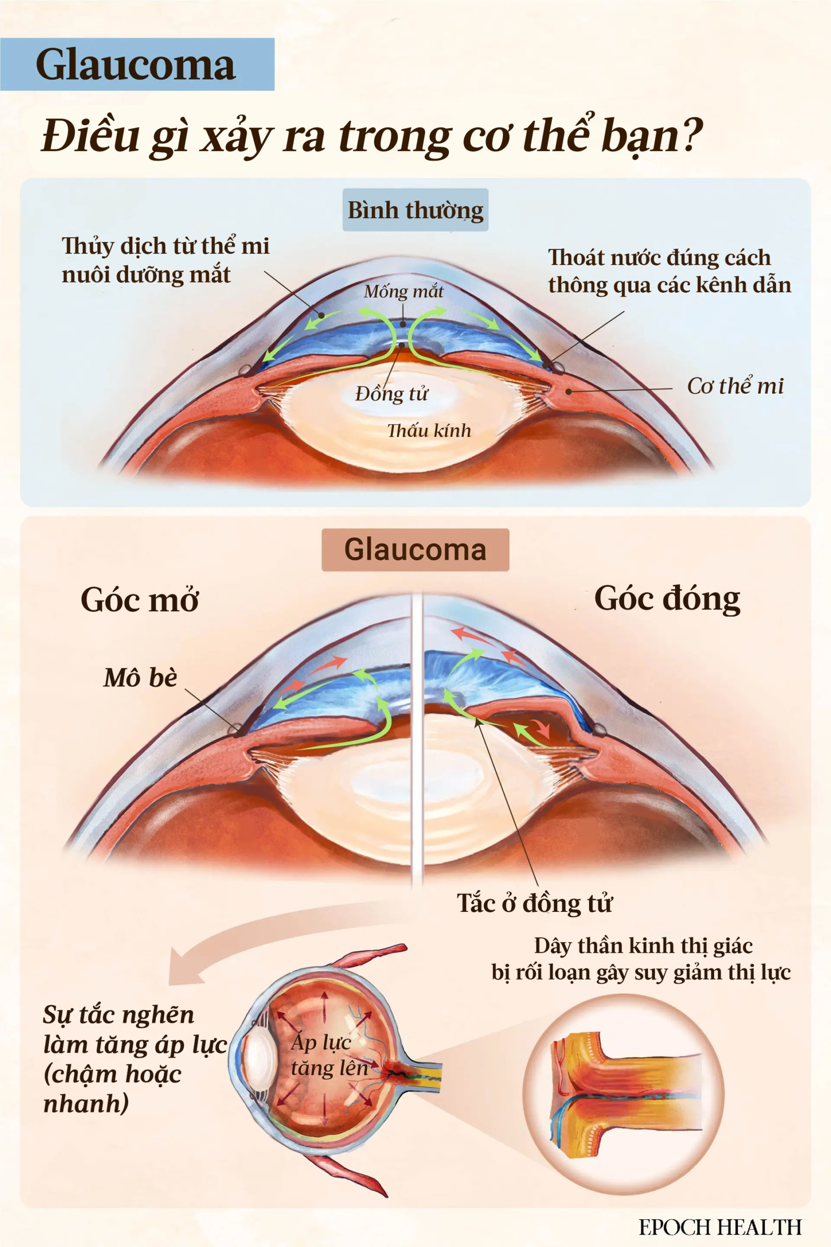 Bệnh tăng nhãn áp: Triệu chứng, nguyên nhân, cách điều trị và phương pháp tiếp cận tự nhiên