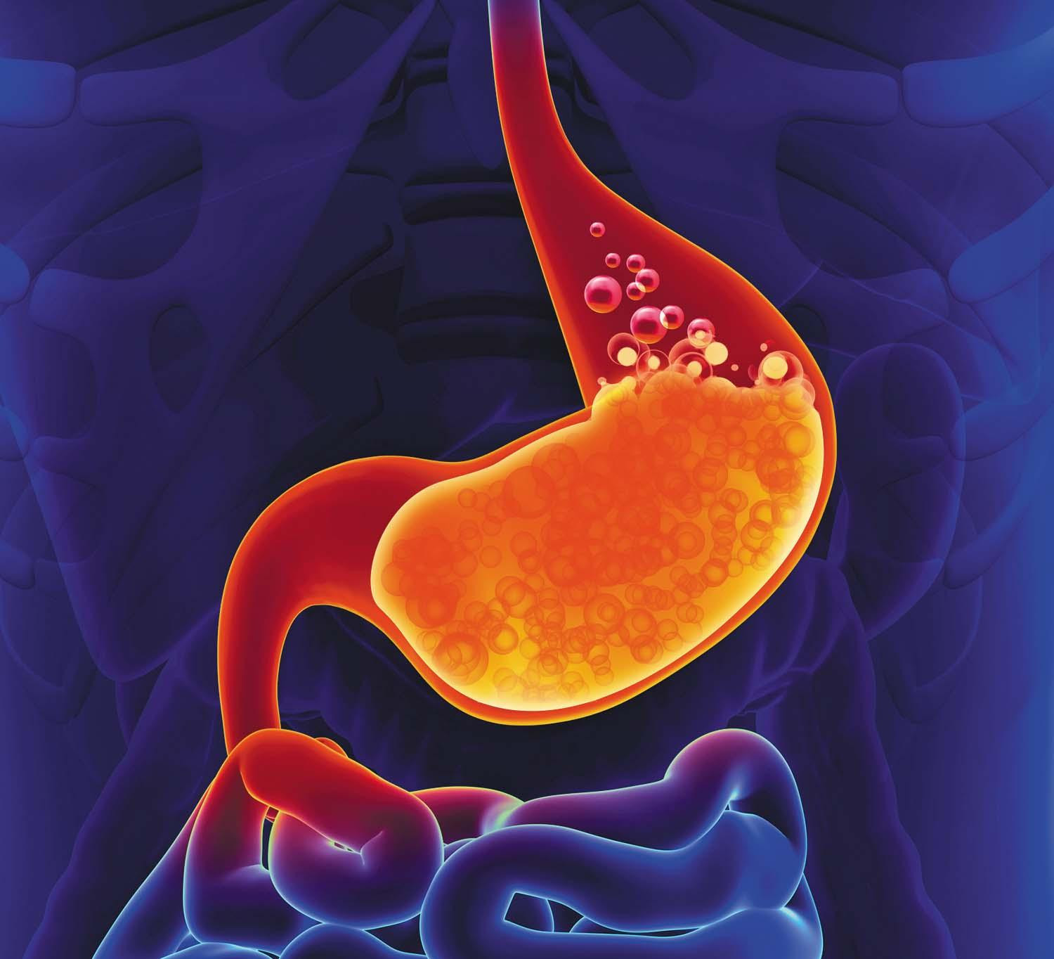 illustration of the stomach, intestine, and part of the esophagus on a dark blue background; the stomach and esophagus are glowing orange, indicating heartburn