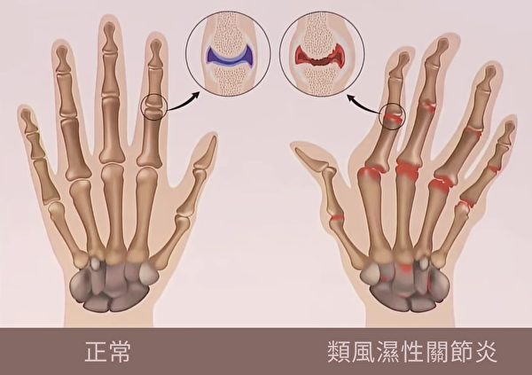 類風濕性關節炎在發病初期時，關節因受到異常的免疫系統攻擊，會疼痛或腫脹。長久下來，會出現僵硬和關節變形。（談古論今話中醫提供）