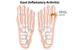 【鄧醫談養生】尿酸升高了，該怎麼辦？