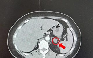 平日血壓難控制 就醫意外發現竟是腎上腺腫瘤作怪