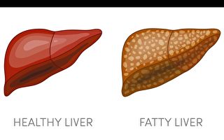 【健康1+1】脂肪肝增肝癌風險 六大原則助逆轉